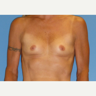 45-54 year old woman treated with Breast Augmentation before 3698248