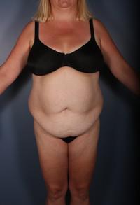 After Weight Loss, Liposuction, Tummy Tuck before 1394280