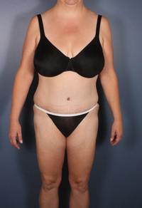 After Weight Loss, Liposuction, Tummy Tuck after 1394280