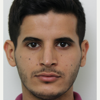 25-34 year old man treated with Revision Rhinoplasty after 3583846