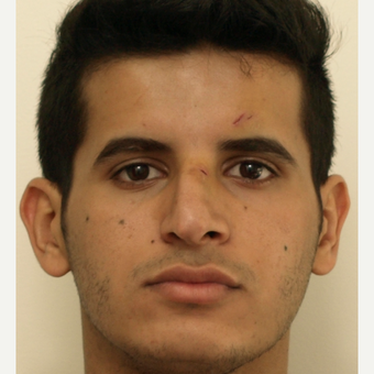 25-34 year old man treated with Revision Rhinoplasty before 3583846