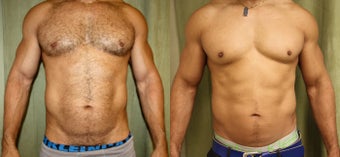 Liposuction before 1164947