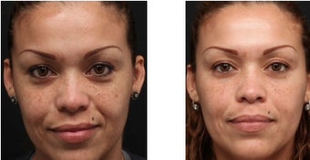 Chemical peel for improved texture and pigmentation. before 1088344