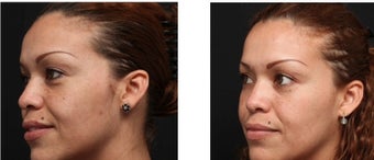 Chemical peel for improved texture and pigmentation. 1088344