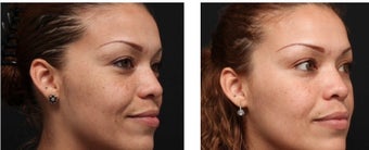 Chemical peel for improved texture and pigmentation. after 1088344