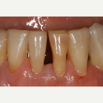 65-74 year old woman treated with ceramic dental crowns on two lower incisors before 3550922