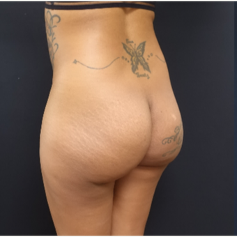 25-34 year old woman treated with Fat Transfer and 712cc Butt Implants before 3129312
