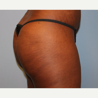 45-54 year old woman treated with Brazilian Butt Lift after 3808991
