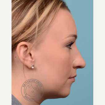 25-34 year old woman treated with open Rhinoplasty/septoplasty before 3092541