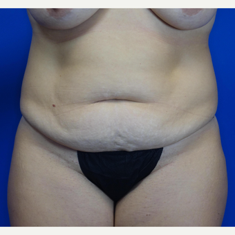 35-44 year old woman treated with Tummy Tuck before 3769530