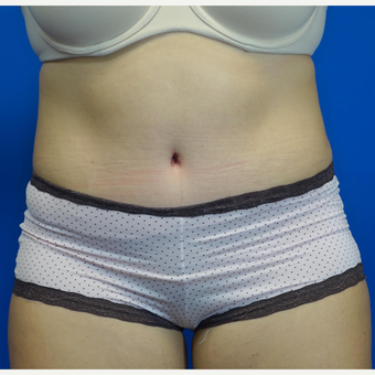 35-44 year old woman treated with Tummy Tuck after 3769530