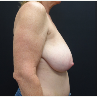 55-64 year old woman treated with Breast Lift before 3130107