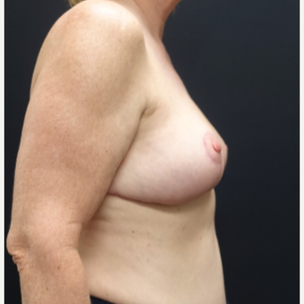 55-64 year old woman treated with Breast Lift after 3130107