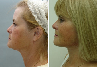 Mid Face Cheek Lift before 1360167