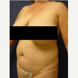45-54 year old woman treated with Mini Tummy Tuck before 2058566
