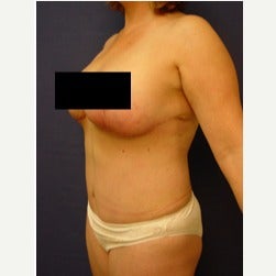 45-54 year old woman treated with Mini Tummy Tuck after 2058566