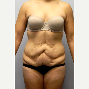 32 year old woman with a history of 110lb weight loss, treated with Tummy Tuck before 3523907