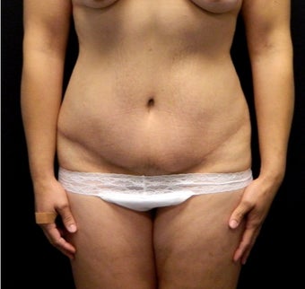 32 year old woman with a history of 110lb weight loss, treated with Tummy Tuck after 3523907