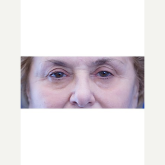 65-74 year old woman treated with Fat Transfer before 3653600