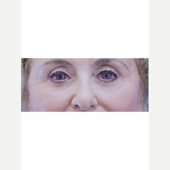 65-74 year old woman treated with Fat Transfer after 3653600