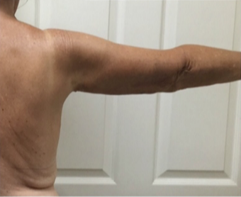 55-64 year old woman treated with Arm Lift 3170043