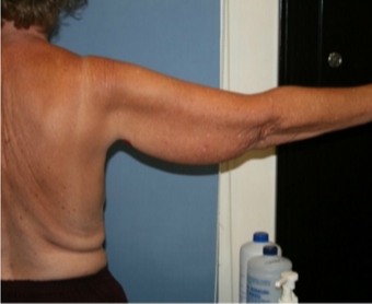 55-64 year old woman treated with Arm Lift 3170043