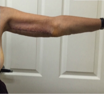 55-64 year old woman treated with Arm Lift after 3170043