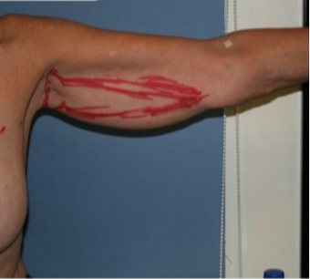 55-64 year old woman treated with Arm Lift before 3170043