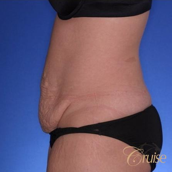 28 year old had a Standard Tummy Tuck before 3584945