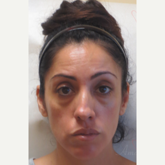 Woman treated with Liquid Facelift (Botox, Restylane & Voluma) before 3197795