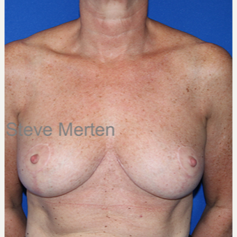 45-54 year old woman treated with Breast Reduction after 3432323