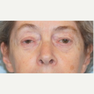65-74 year old woman treated with Ptosis Surgery before 3727854