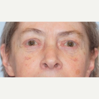 65-74 year old woman treated with Ptosis Surgery after 3727854