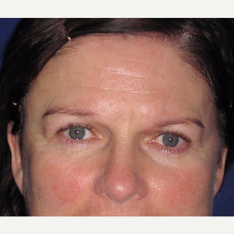 Browlift before 3084689