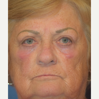 65-74 year old woman treated with Eyelid Surgery after 2885547