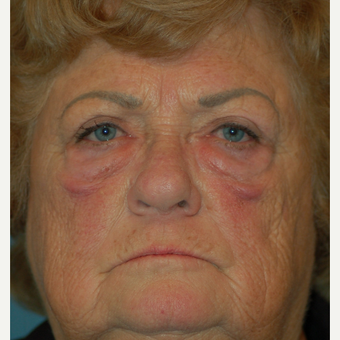 65-74 year old woman treated with Eyelid Surgery before 2885547