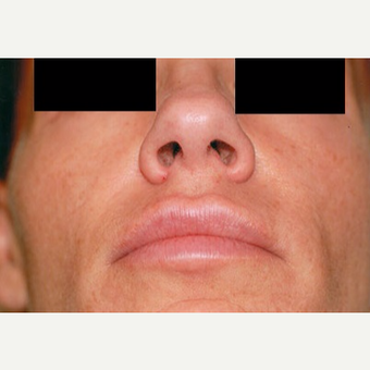 35-44 year old woman treated with Rhinoplasty before 3406256