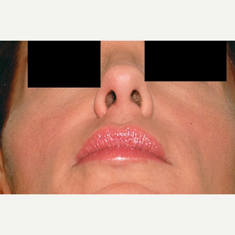 35-44 year old woman treated with Rhinoplasty after 3406256