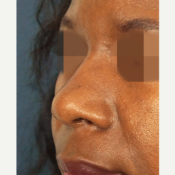 45-54 year old woman treated with Non Surgical Nose Job after 3244839