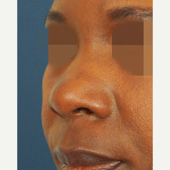 45-54 year old woman treated with Non Surgical Nose Job before 3244839