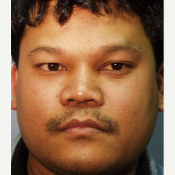 25-34 year old man treated with Rhinoplasty after 3705163