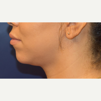 25-34 year old woman treated with Liposuction before 3496688