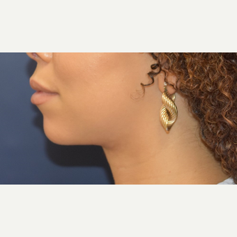 25-34 year old woman treated with Liposuction after 3496688