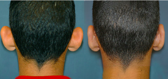 Young male wanted less projected Ears before 1111458