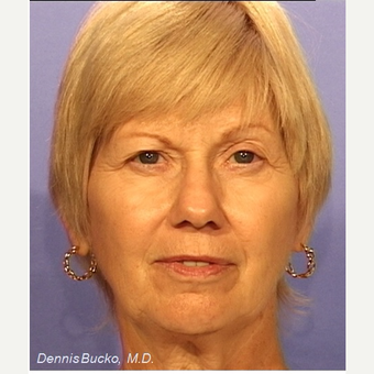 55-64 year old woman treated with Facelift before 3522892