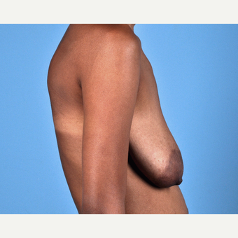 18-24 year old woman treated with Breast Lift before 3837689
