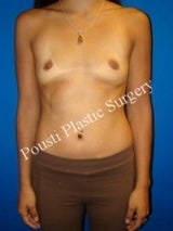 Breast Implant Removal after 1264955