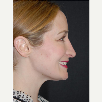25-34 year old woman treated with Non Surgical Nose Job after 2728404