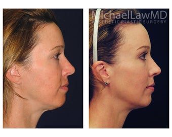 Chin Liposuction before 1256360