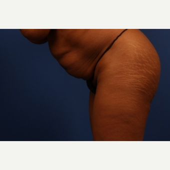 Tummy Tuck before 3743908